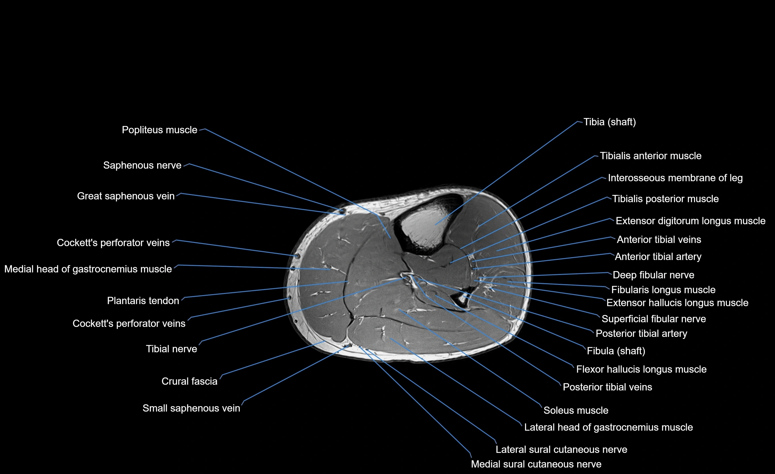 MRI lower leg axial cross sectional anatomy 3T  radiology  image-img-00001-00034.webp
